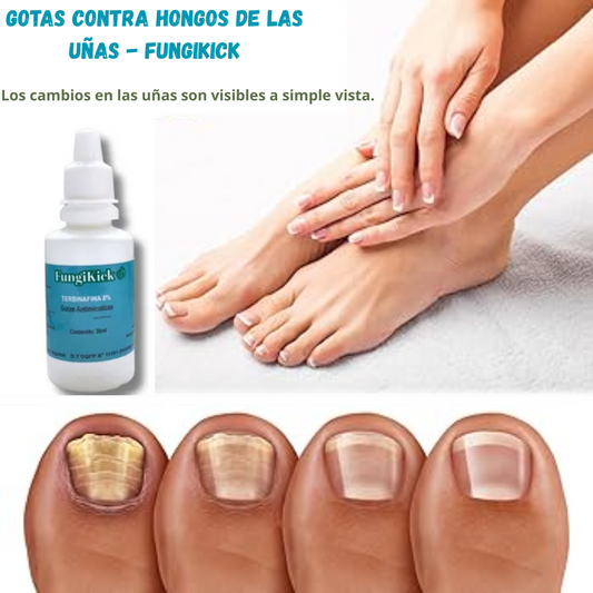Gotas Contra Hongos De Las Uñas - FungiKick